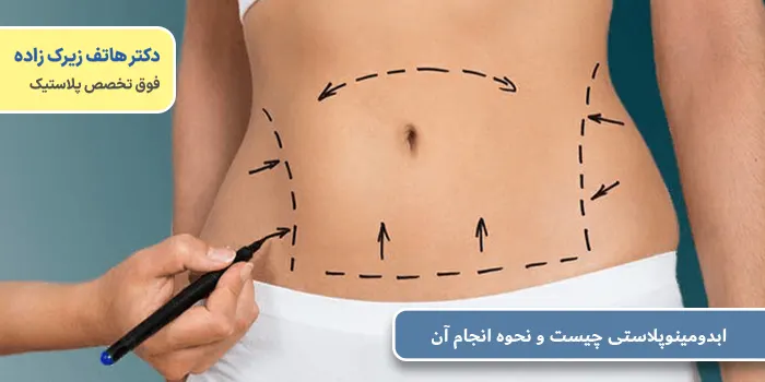ابدومینوپلاستی چیست و نحوه انجام آن