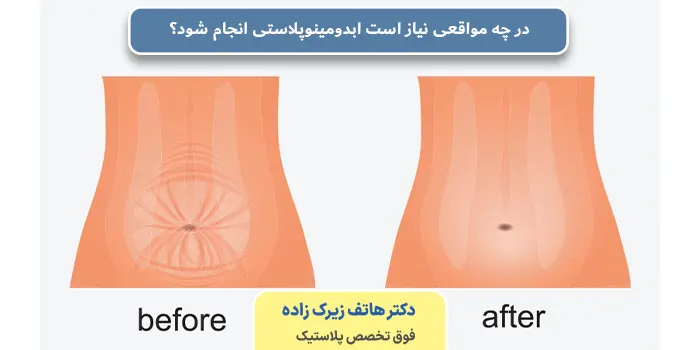 در چه مواقعی نیاز است ابدومینوپلاستی انجام شود؟