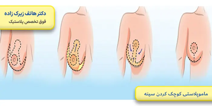 ماموپلاستی کوچک کردن سینه