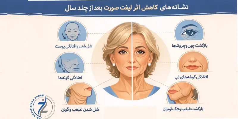 نشانههای کاهش اثر لیفت صورت بعد از چند سال