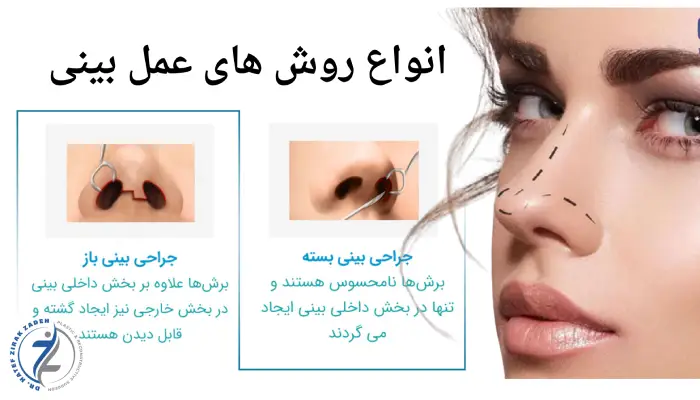 انواع روش های عمل بینی