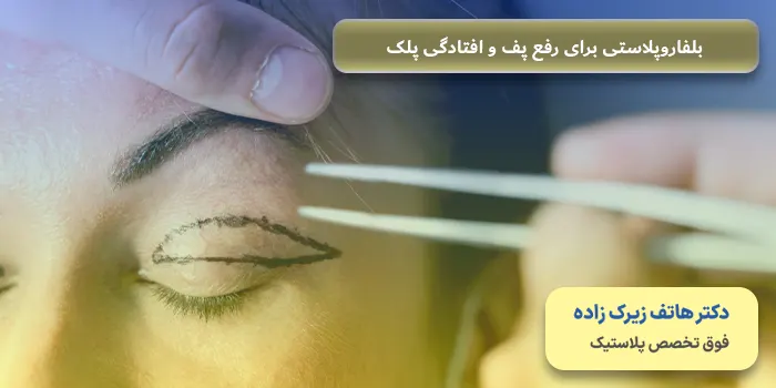 بلفاروپلاستی چیست؟