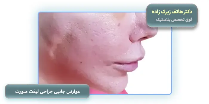 عوارض جانبی جراحی لیفت صورت