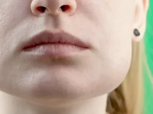 ورم بعد از جراحی لیفت صورت