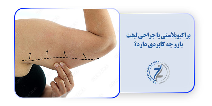 براکیوپلاستی یا جراحی لیفت بازو چه کابردی دارد؟