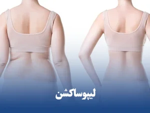 لیپوساکشن