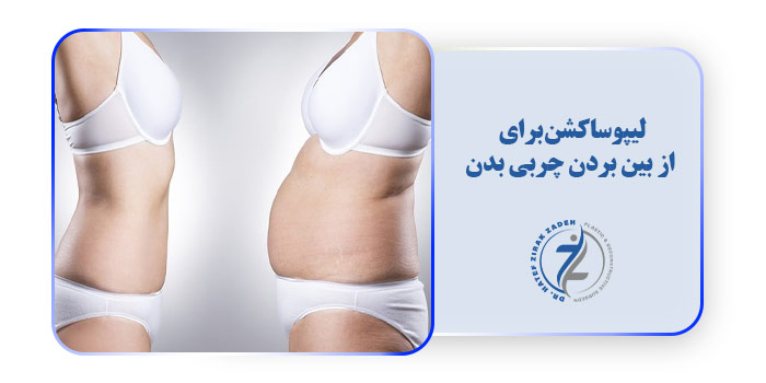 لیپوساکشن برای از بین بردن چربی بدن