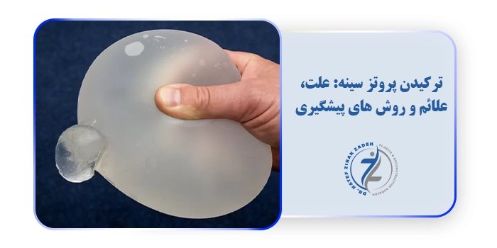 ترکیدن پروتز سینه: علت، علائم و روش های پیشگیری
