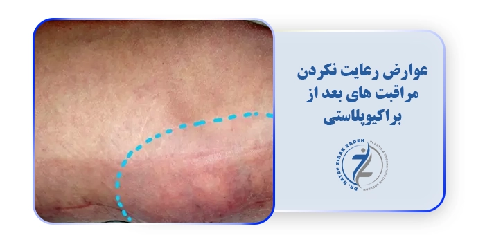 عوارض رعایت نکردن مراقبت های بعد از براکیوپلاستی