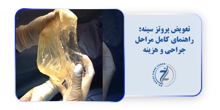تعویض پروتز سینه: راهنمای کامل مراحل جراحی و هزینه