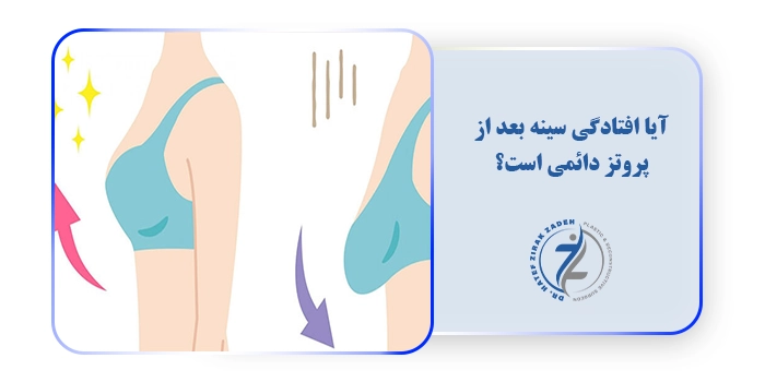 آیا افتادگی سینه بعد از پروتز دائمی است؟