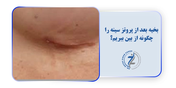 بخیه بعد از پروتز سینه را چگونه از بین ببریم؟