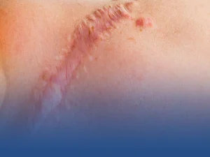 ترمیم جای بخیه پروتز سینه