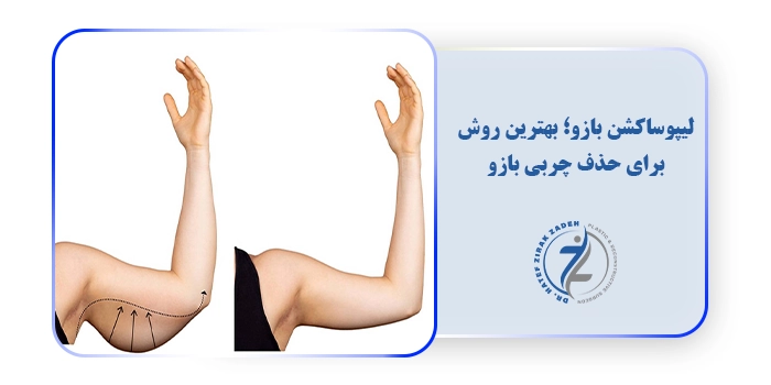 لیپوساکشن بازو؛ بهترین روش برای حذف چربی بازو
