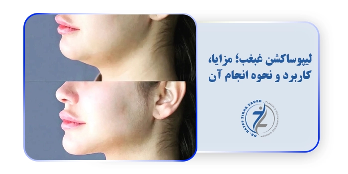 لیپوساکشن غبغب؛ مزایا، کاربرد و نحوه انجام آن