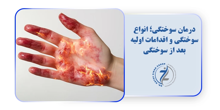 درمان سوختگی؛ انواع سوختگی و اقدامات اولیه بعد از سوختگی