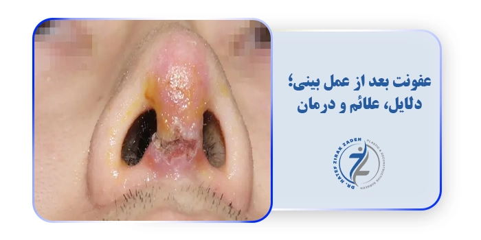 عفونت بعد از عمل بینی؛ دلایل، علائم و درمان