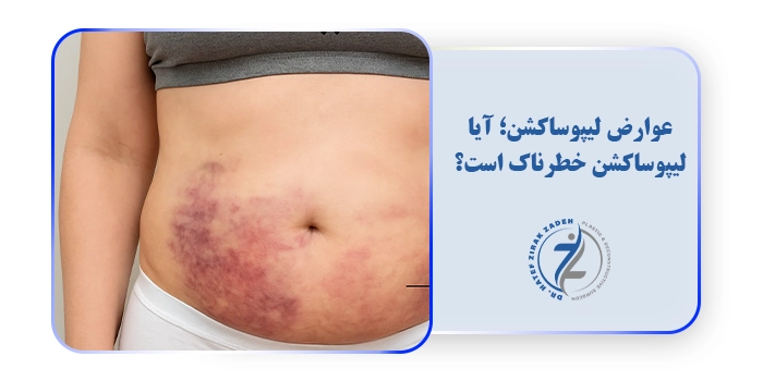 عوارض لیپوساکشن؛ آیا لیپوساکشن خطرناک است؟