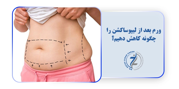 ورم بعد از لیپوساکشن را چگونه کاهش دهیم؟