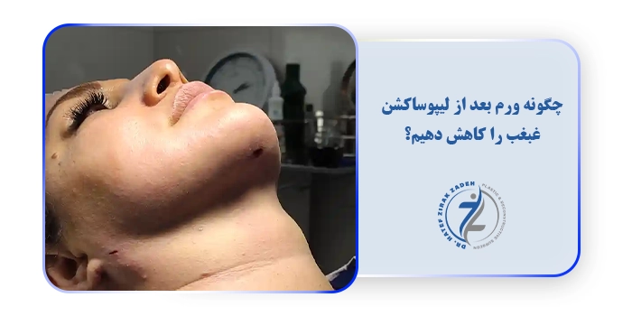 چگونه ورم بعد از لیپوساکشن غبغب را کاهش دهیم؟