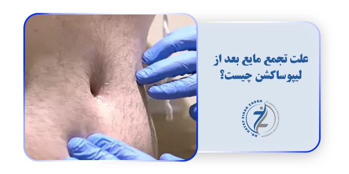 علت تجمع مایع بعد از لیپوساکشن چیست؟