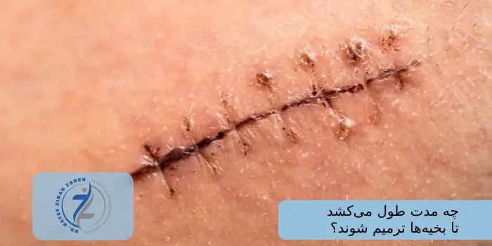 چه مدت طول میکشد تا بخیهها ترمیم شوند؟