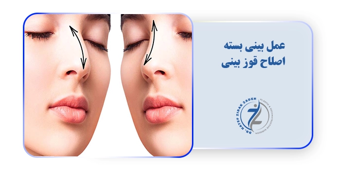 عمل بینی بسته اصلاح قوز بینی