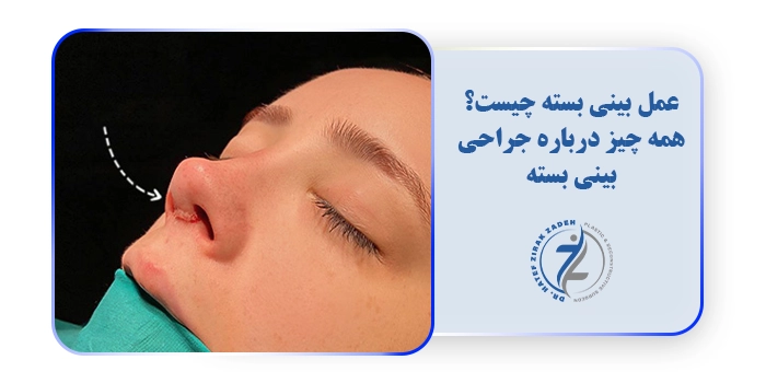 عمل بینی بسته چیست؟