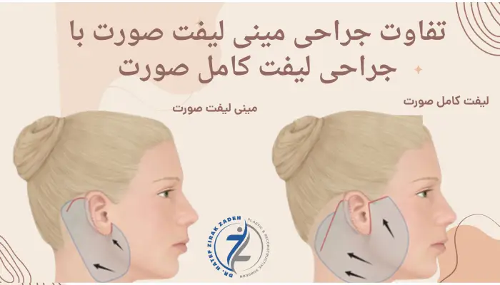 تفاوت جراحی مینی لیفت صورت با جراحی لیفت کامل صورت