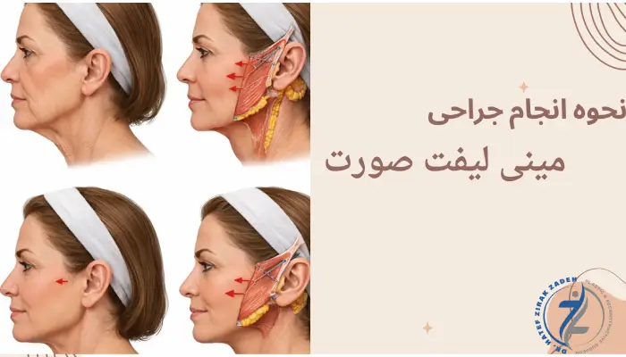 جراحی مینی لیفت صورت+هزینه و مراقبت ها